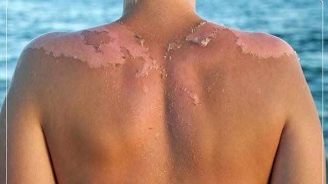 آفتاب ملایم صبح و عصر هم به DNA پوستتان آسیب می‌زند