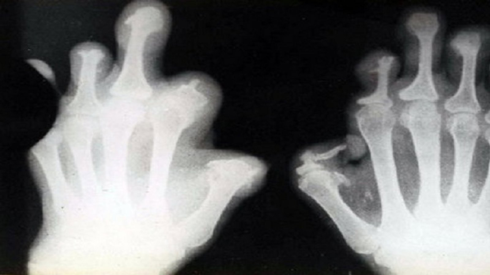 189 بیمار جذامی در اورمیه زندگی می کنند